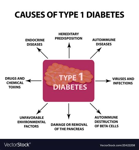 Causes Of Diabetes Type 1 Infographics Royalty Free Vector