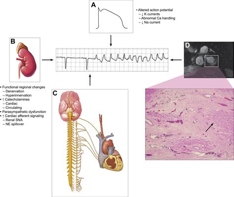 Sudden death mechanisms in nonischemic cardiomyopathies: Insights gleaned from clinical 