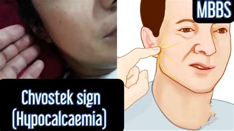 Chvostek Sign Seen In Hypocalcaemia Mbbs Medicine Neet Neetpg Usmle
