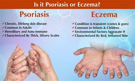 Natural Help For Eczema And Psoriasis