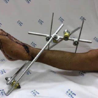Delta Type External Fixator Placed In A Patient With Good Skin Healing