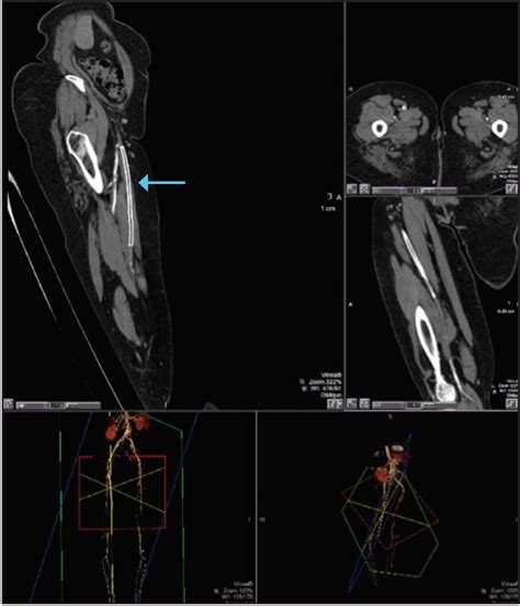 Endovascular Today Ct Reconstruction In Critical Limb Ischemia