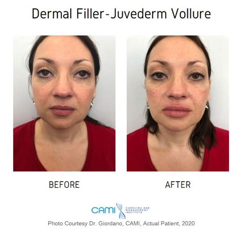 Face Fillers Before After Pictures Dermal Fillers Before After
