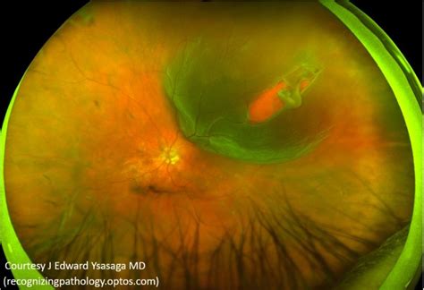 When we are young, the vitreous gel inside the eye is like jello fresh out of the. Retinal Detachment Vitreoretinal Surgery — Hereford Eye ...