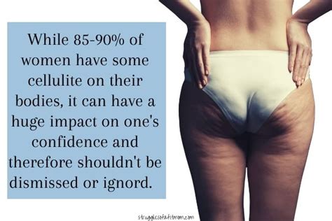 Cellulite During Pregnancy Debunking Unrealistic Expectations