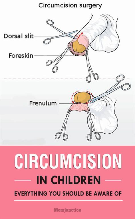 Circumcision Explained