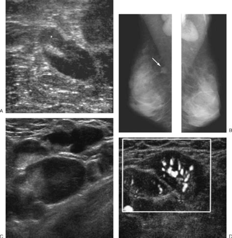 Ultrasound Of The Breast Radiology Key