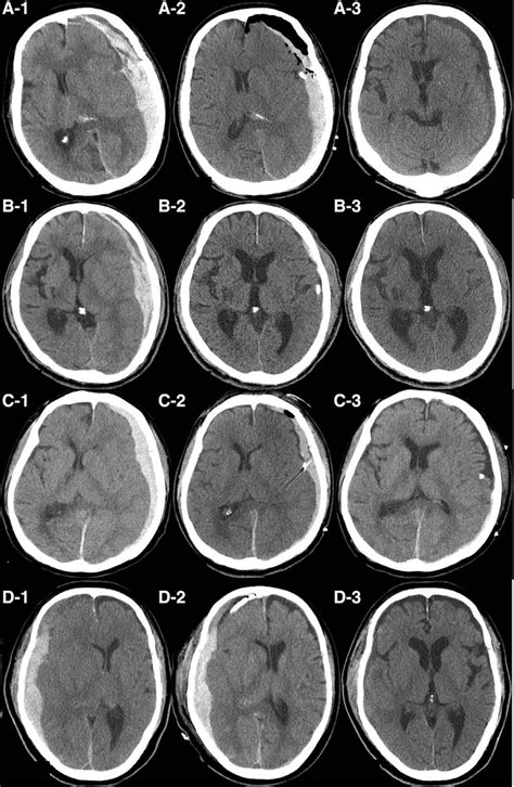 Serial Non Contrast Brain Ct Images Of Illustrative Cases Preoperative