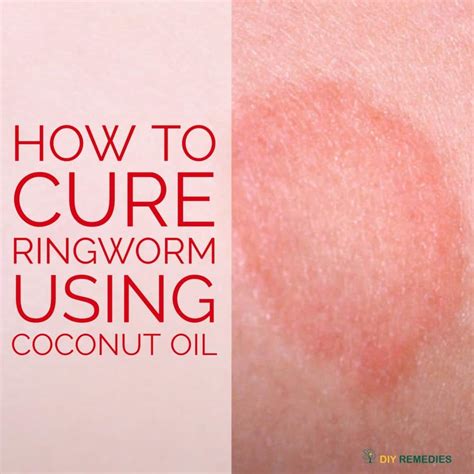 How To Cure Ringworm Using Coconut Oil