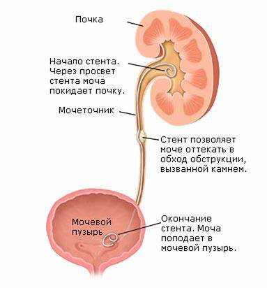 Диета после приступа почечной колики