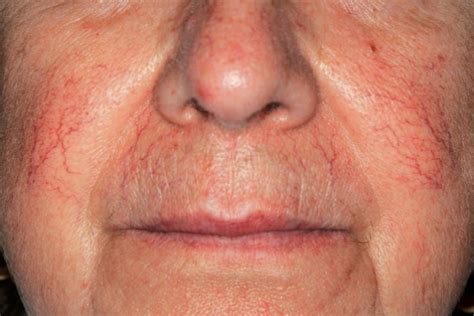 Facial And Leg Veins Red Spots And Vessels Dermatology On Bloor