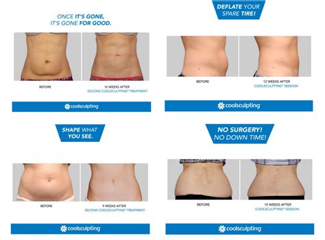 Coolsculpting Fat Removal Reviews Colororient