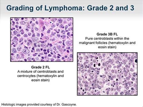Follicular Lymphoma: Evaluating First-Line Treatment Options (Transcript)