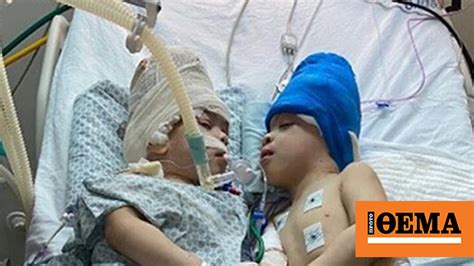 Conjoined Twins With Fused Brains Successfully Separated Thanks To Uk