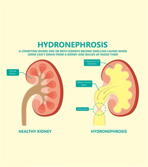 Hydronephrosis In Babies Causes Symptoms And Treatment My Best