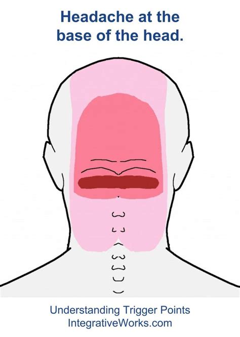 Understanding Trigger Points Headache At The Base Of The Head That