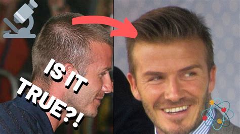 David Beckham Hair Transplant Whats The Truth Youtube