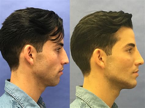Surgery To Get A Chiseled Jawline Askgaybros