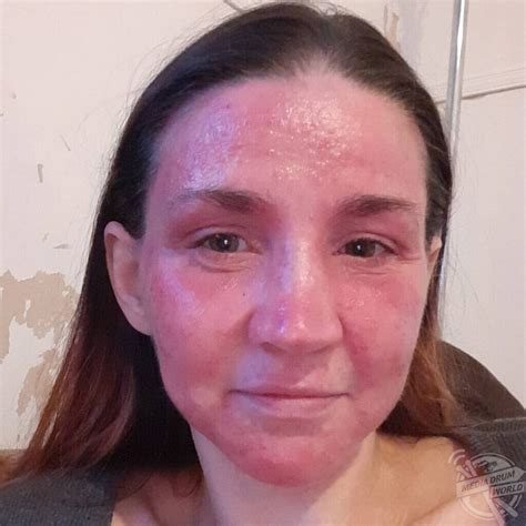 This Womans Skin Has Been Damaged So Much By Steroid Creams That