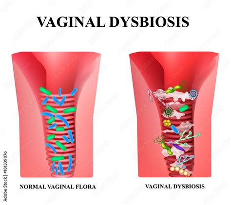 Vaginal Dysbiosis Dysbacteriosis Of The Vagina Vaginitis Candidiasis