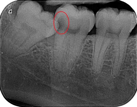 Is It Wise To Remove My Wisdom Teeth Medisave Claimable For Surgery