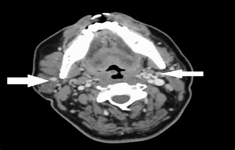Ct Scan Of Neck Showing Bilateral Multi Level Cervical Lymph Nodes