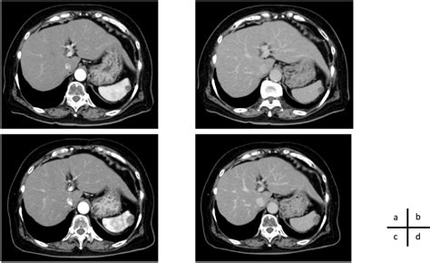 Contrast Enhanced Ct Scans Obtained In Case 1 Initial Visit A