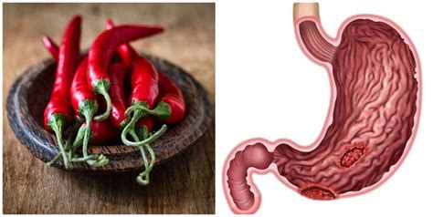Is Chilli Pepper Good For Ulcer Effects Of Capsaicin On Stomach Ulcers