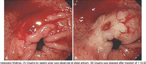 Duodenal Ulcer Endoscopy