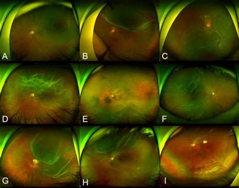 Scleral Buckling In The Management Of Rhegmatogenous Retinal Detachmen