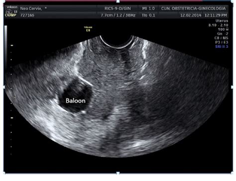 Transvaginal Ultrasound Showing A Large Cervical Cancer In Longitudinal