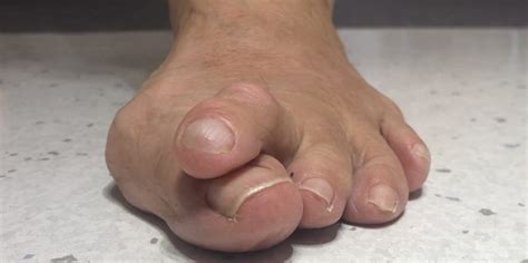 Hammer Toes Causes Diagnosis Treatment Foot And Ankle