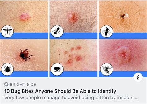 10 Bug Bites Anyone Should Be Able To Identify Bug Bites Household