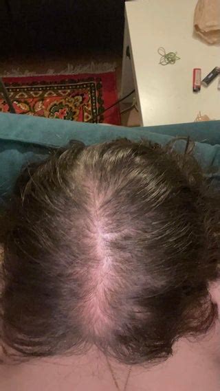 2 Months Minoxidil Rfemalehairloss