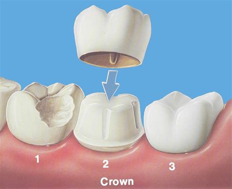 If you have a loose permanent tooth, you should call a dentist right away. Why Your Dental Crown Came Off | DentalPlans Blog