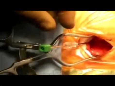 Die implantierbare lenus pro pumpe für die. Pump Implantation by Joe Ordia, M.D..mp4 - YouTube