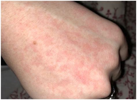 The Clindamycin Catastrophe A Case Of Antibiotic Induced Skin Eruption
