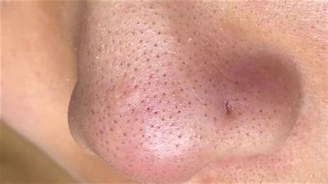 Remove Small Blackheads On Nose 03 Youtube