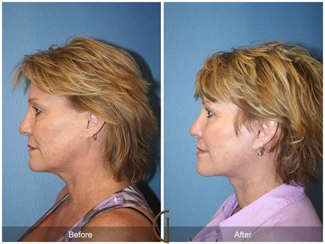 Facelift Fifties Before And After Photos Patient 37 Dr Kevin Sadati