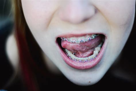 Braces Are Adorable Flickr