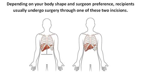Liver Transplant Surgery Guide