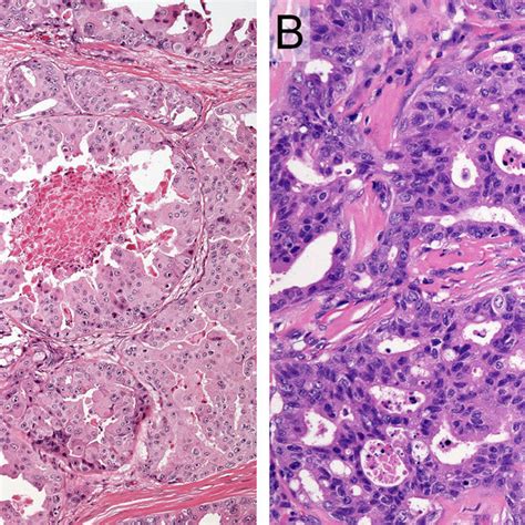 Representative Histologic Features Of Salivary Duct Carcinoma Case A