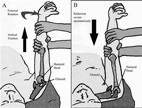 Reduction Of Anterior Shoulder Dislocations By Spaso Technique