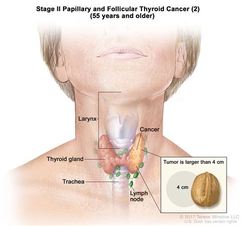 Thyroid Cancer Treatment Pdq Nci