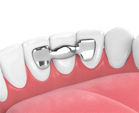 Puentes dentales Información recomendaciones y tipos existentes