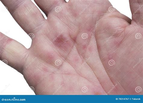 Hand Foot And Mouth Disease Stock Image Image Of Isolated Adult