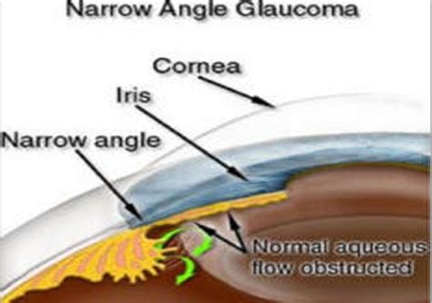 Angle Closure Glaucoma And Anatomically Narrow Angles North Atlanta