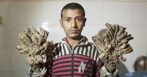 Man With Rare Skin Disease Has Tree Roots Growing From His Hands
