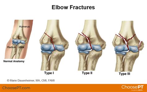 Guide Physical Therapy Guide To Elbow Fracture Choose Pt