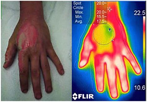 A Real Image Of A Burn Wound Compared With A Thermographic Image Of The